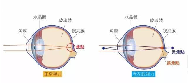 500度近視又老花，戴上美麗島多焦鏡煩惱全解決，46歲的周先生樂(lè )壞了